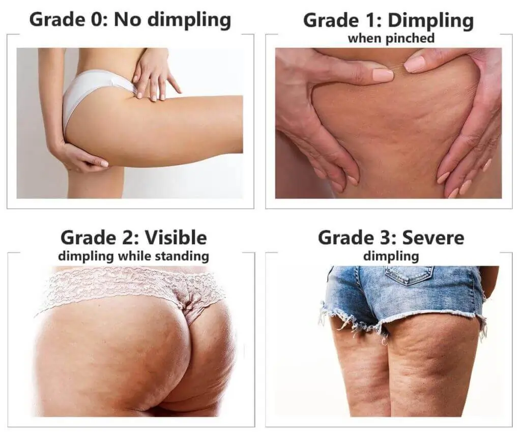 Representation of the stages of cellulite development Poole